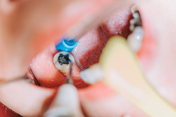 Fillings